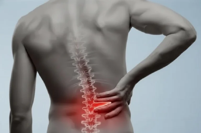 L4-L5 Slipped Disc diagram showing nerve compression and spinal anatomy.