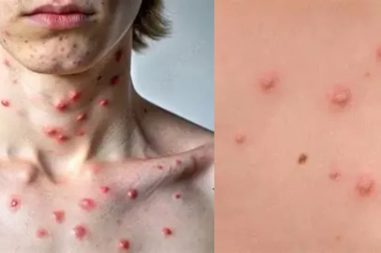 Child checking red skin rash in mirror at home representing chickenpox symptoms and care and early symptoms awareness.